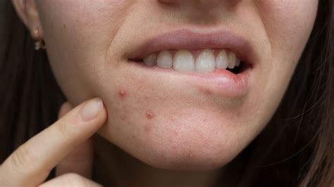 What Causes Acne Near Mouth